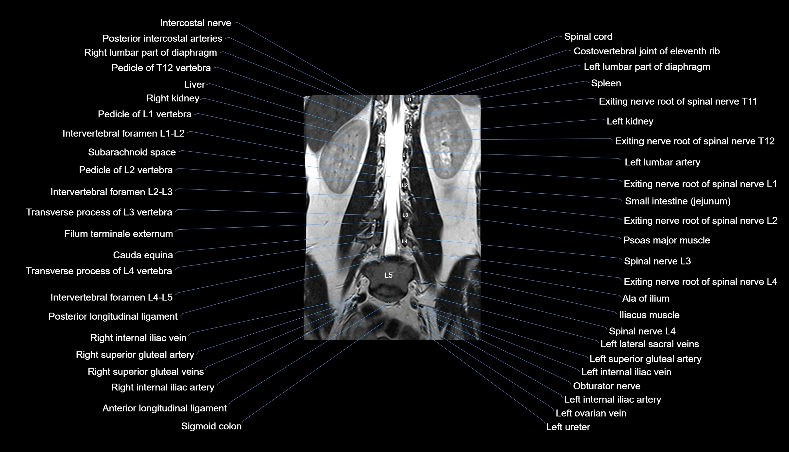 MRI lumbar spine labelled coronal cross sectional anatomy 3T radiology-img-00001-00018.webp